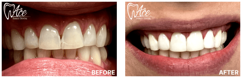 Chairside veneer transformation — before and after