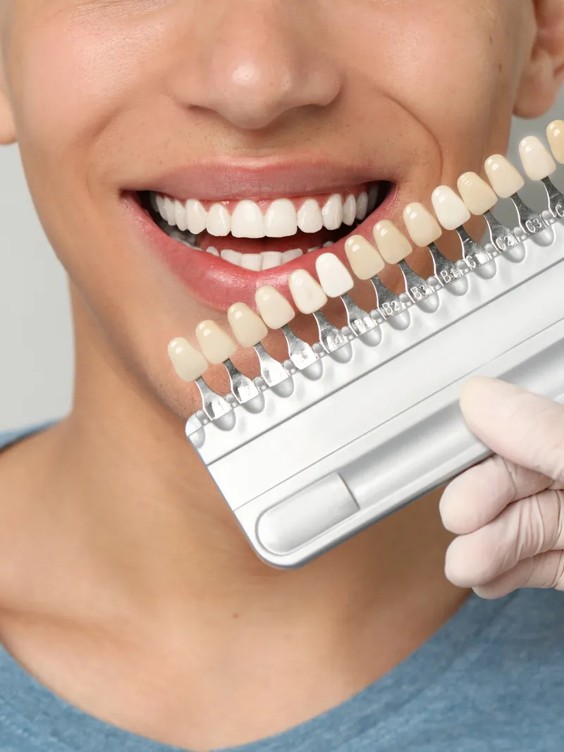 Dental Veneers in Alpharetta and Norcross GA - Ace Family Dental