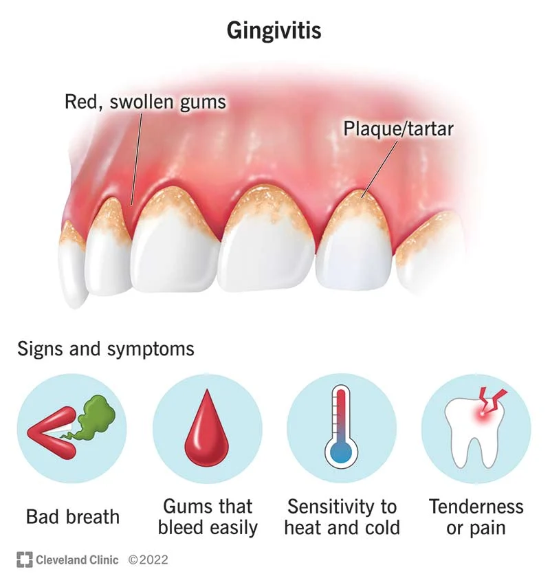 The Signs And Symptoms Of Gum Disease Dentist Norcross Alpharetta GA